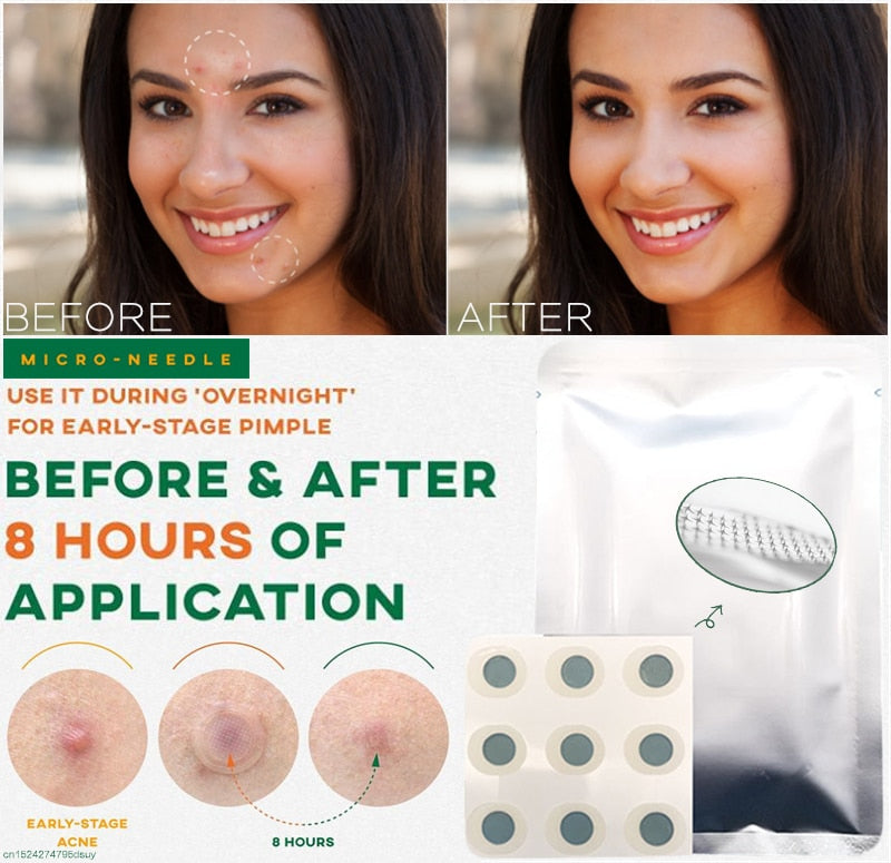 9 Patches Microneedle Acne Pimple Healing Patch Anti Acne Pimple Patch Soothing Face Skin Healing Zit Stickers Blemish Treatment