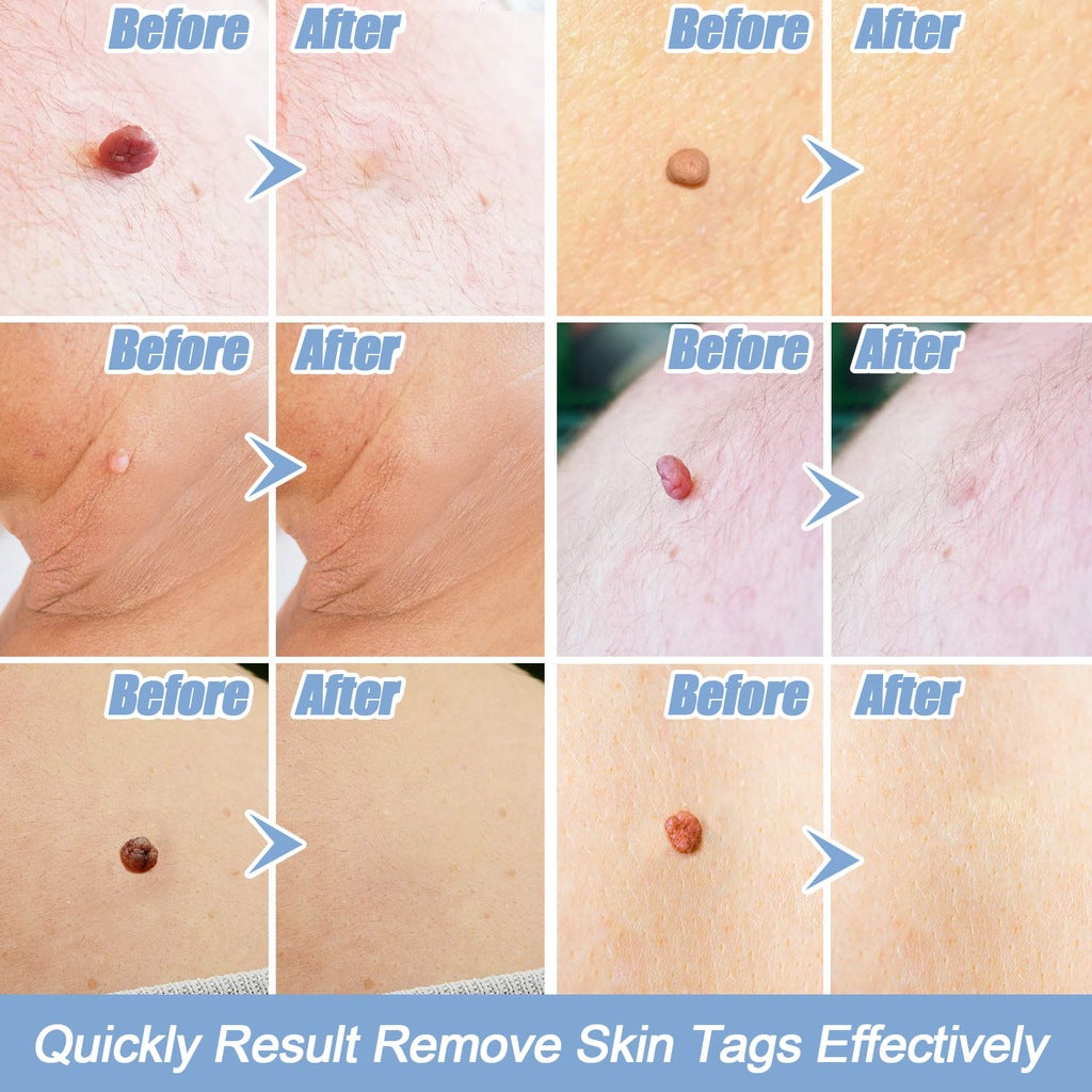 Skin Tag Removal Acne Remover Wart Remover Skin Tag Remover Skin Tag Remover