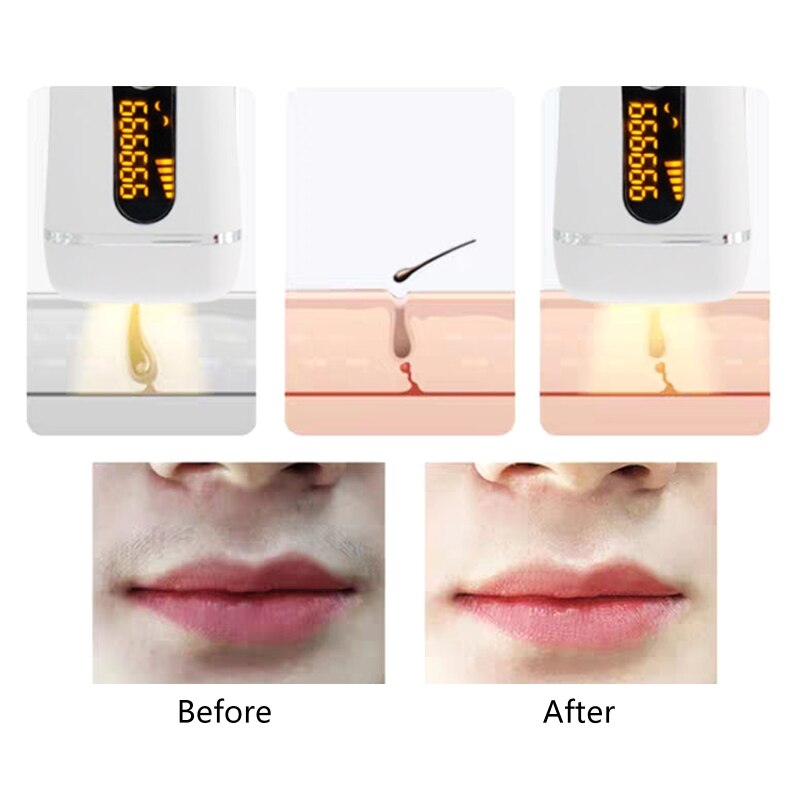 Photonic IPL Laser Hair Removal Instrument Multi-functional Portable Painless Hair Removal Instrument Your Lips Armpitsï¼ˆDYM-011ï¼‰