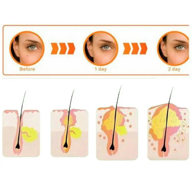 36pcs Remover Pimple Master Patch Acne Treatment Protects Invisible Acne Patch Face Care Cosmetics Face Skin Care Tools